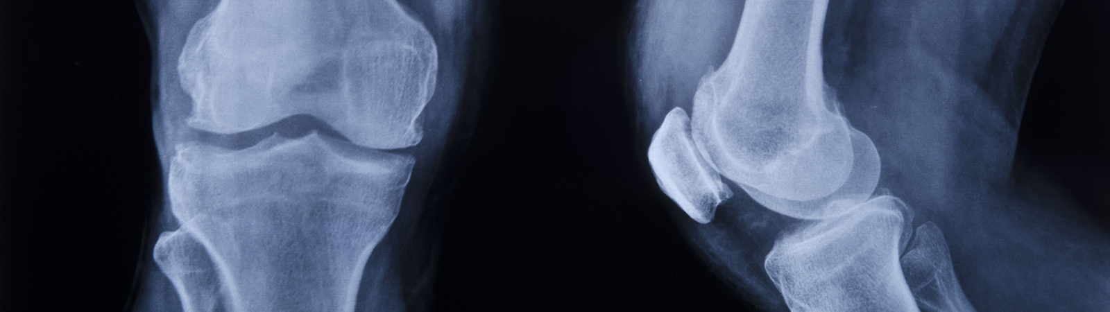 Radiografia Ossea